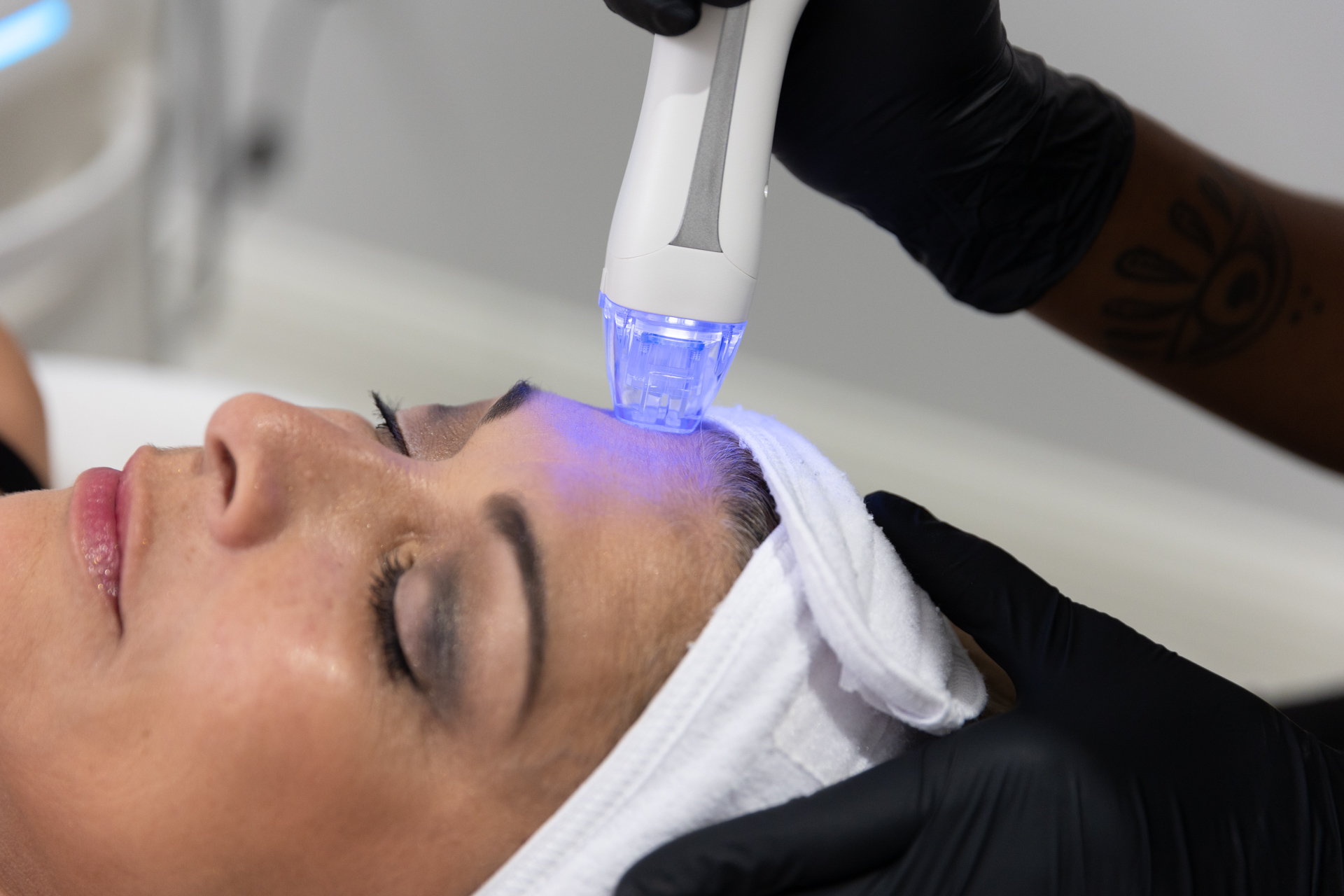 A provider uses RF microneedling before combining it with CoolPeel near Sarasota.