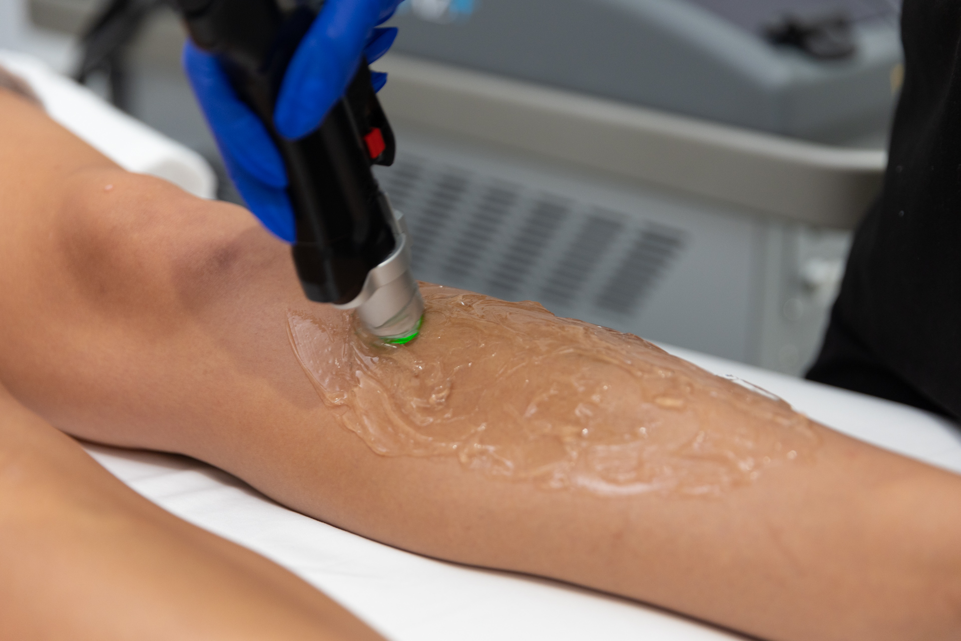 Provider using a laser device and gel on patient's leg during Laser Hair Removal in North Port